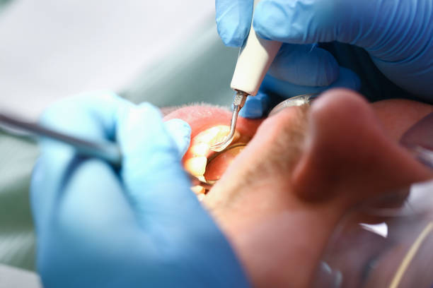 Best Emergency Broken Tooth Repair in Burien, WA
